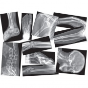 Roylco Broken Bones X-rays Set (R5914)